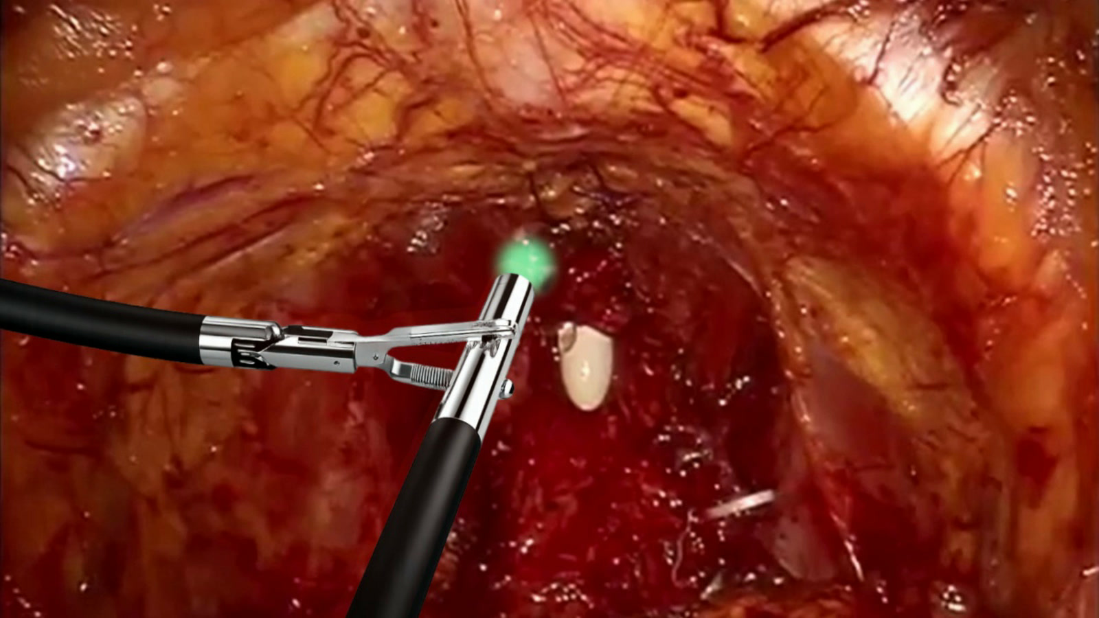 The Probentis probe at the surgical margin, its light green where the reading is clear.
