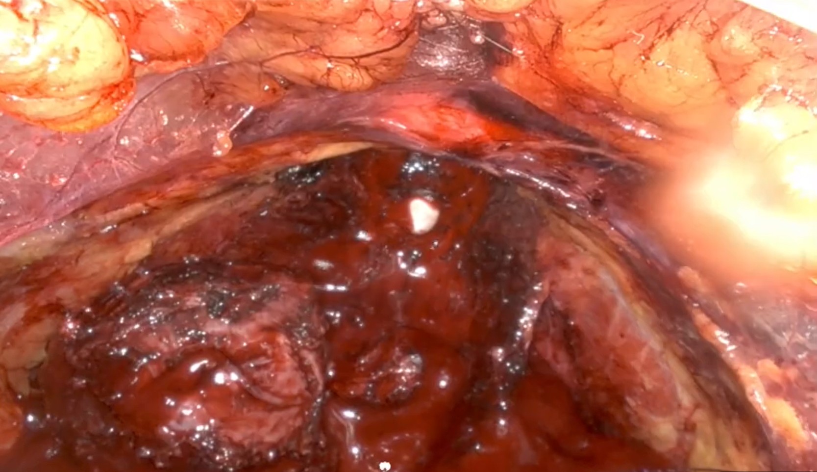 Living prostate tissue at the surgical margin, viewed through the Probentis probe.